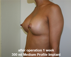 plastic-surgery-breast-augmentation